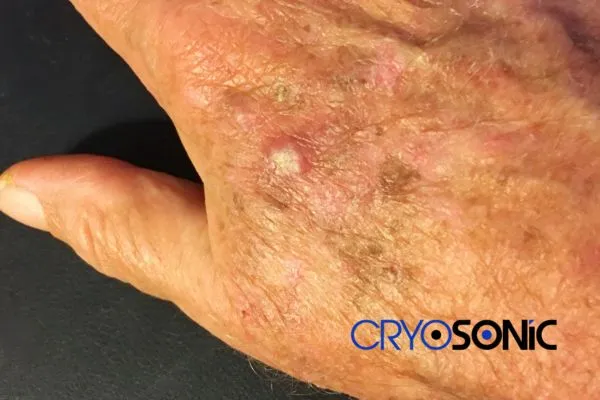 Book Your Actinic Keratosis removal Henley on Thames treatment Today Henley on Thames