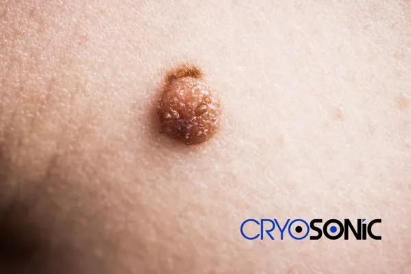 Are you looking for local Dermatofibroma Removal Bristol? Contact our team today in Henley on Thames