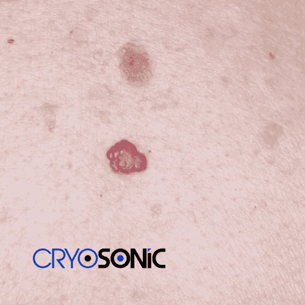 Looking for pain free cherry angioma removal treatment Henley on Thames? Call our team today! Henley on Thames