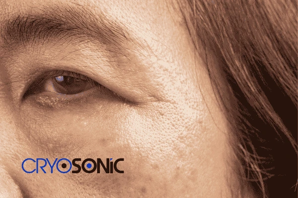 Start age spots removal Henley on Thames treatment today! Call our team now! Henley on Thames