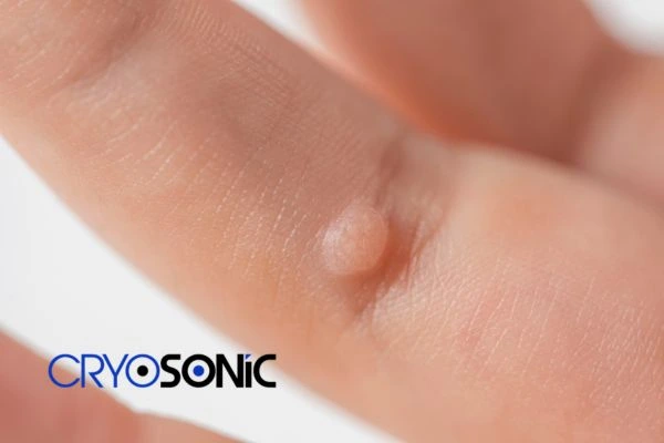 Contact Cryosonic today to learn more about us Henley on Thames now! Henley on Thames