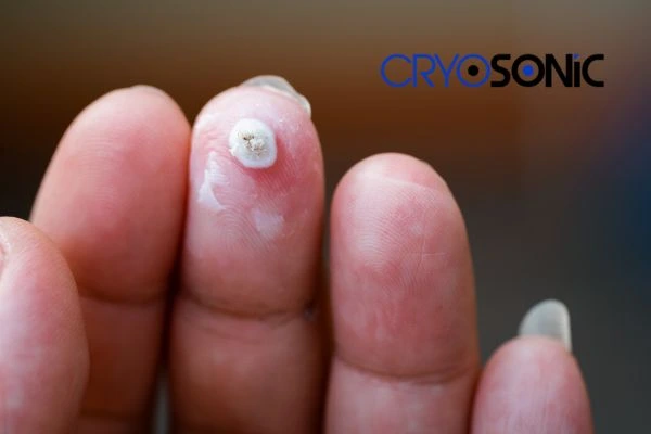 Learn more about us Henley on Thames at Cryosonic. Book in today! Henley on Thames