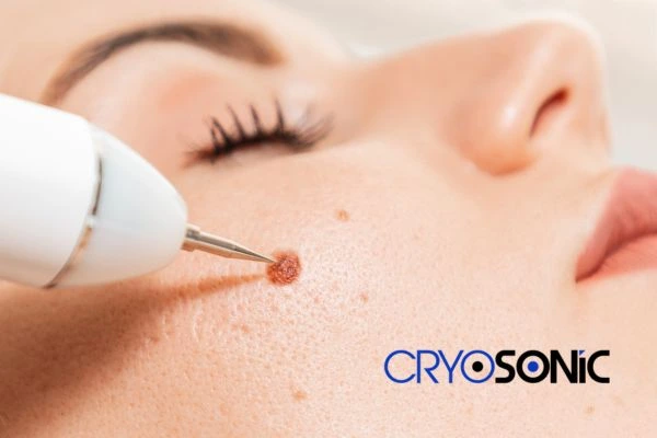 why choose us at Cryosonic for blemish removal? Find out more now Henley on Thames