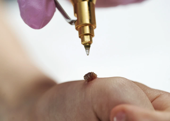Cryopen For Children Bristol Henley on Thames