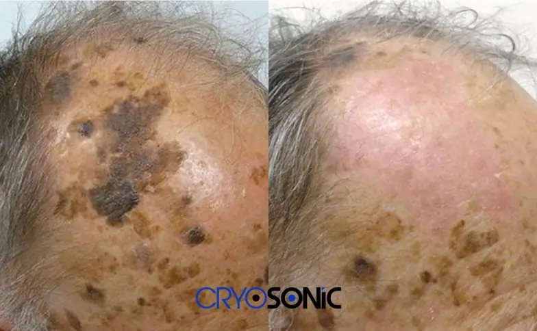 Seborrhoeic Keratosis Removal before and after Henley on Thames