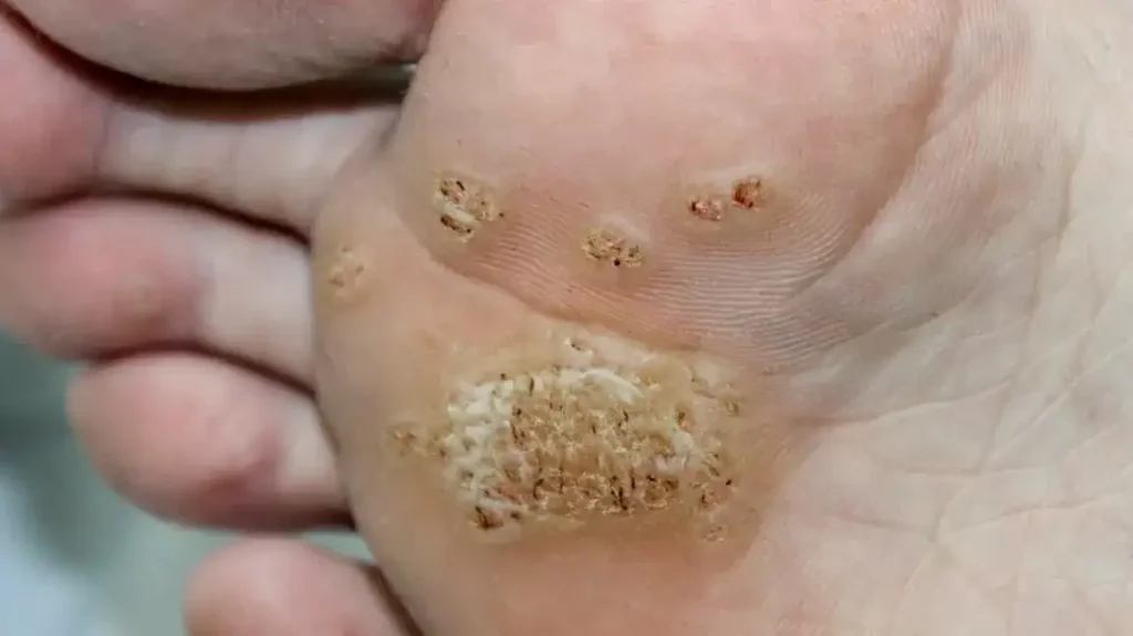 Secure Your Wart Removal Appointment with One Click Henley on Thames