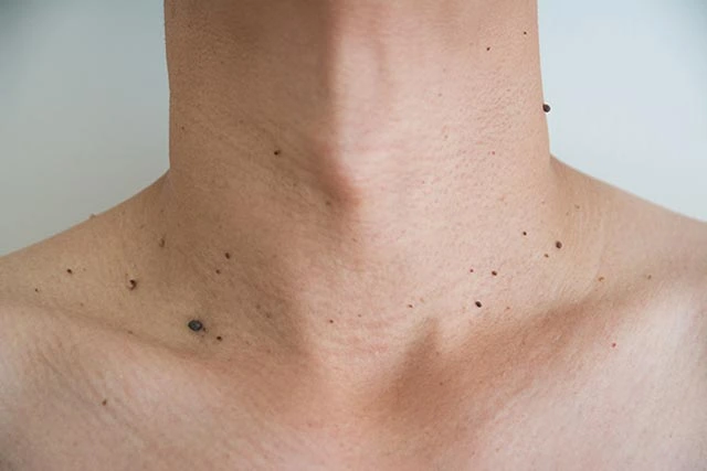 What to Avoid After Benign Mole Treatment in Henley on Thames Henley on Thames