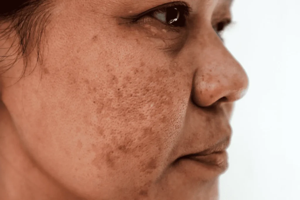 Aftercare Advice for Sun Damage Treatment Henley on Thames