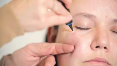 Aftercare Advice Following Milia Removal in Henley on Thames