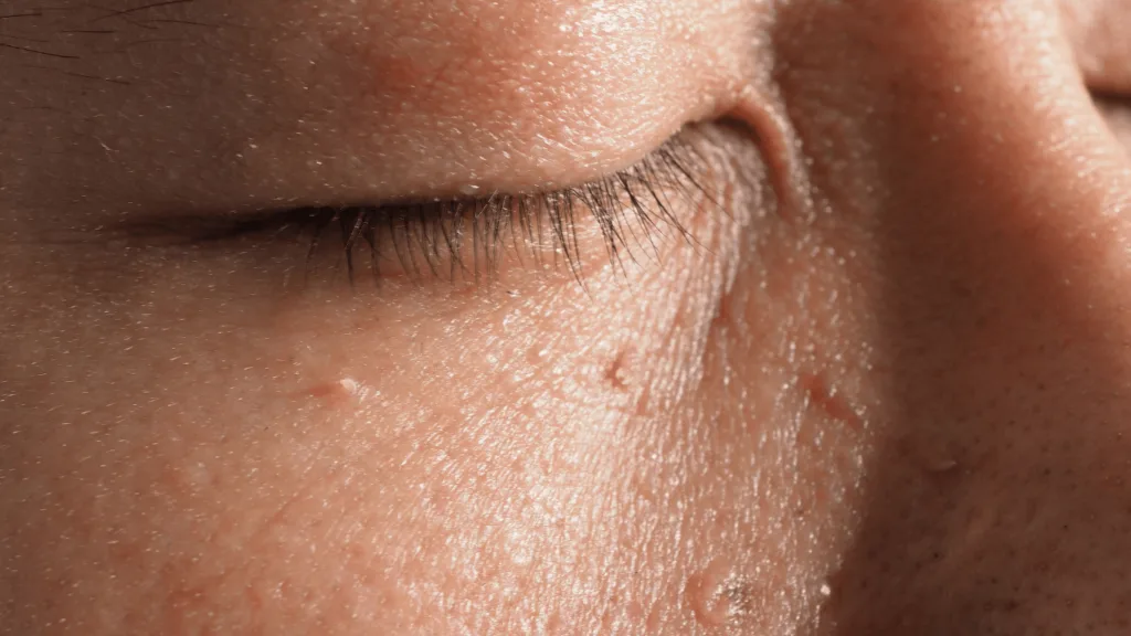 Frequently Asked Questions about Skin Tag Removal Henley on Thames