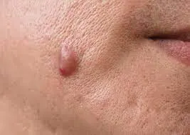 Skin Tags Recovery Time and Skin Healing Expectations Henley on Thames