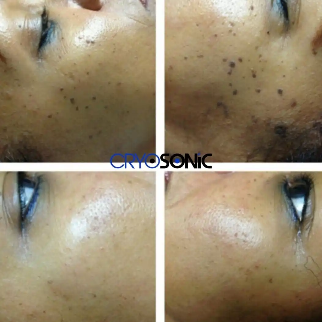 Why Skin Shows Pigmentation After Treatment Henley on Thames