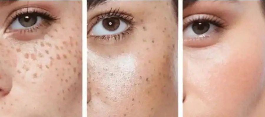 Ephelides Removal Results and Healing Timeline Henley on Thames