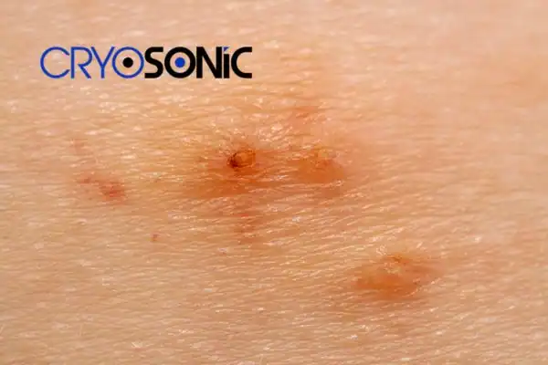 Image of Molluscum Contagiosum Treatment Henley on Thames Henley on Thames