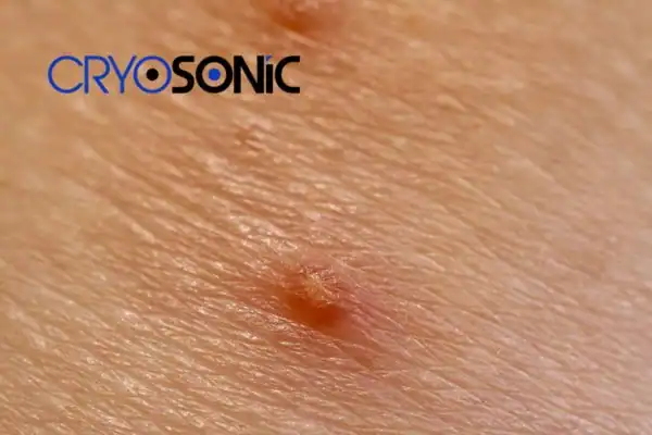 Molluscum Contagiosum Treatment Henley on Thames Henley on Thames