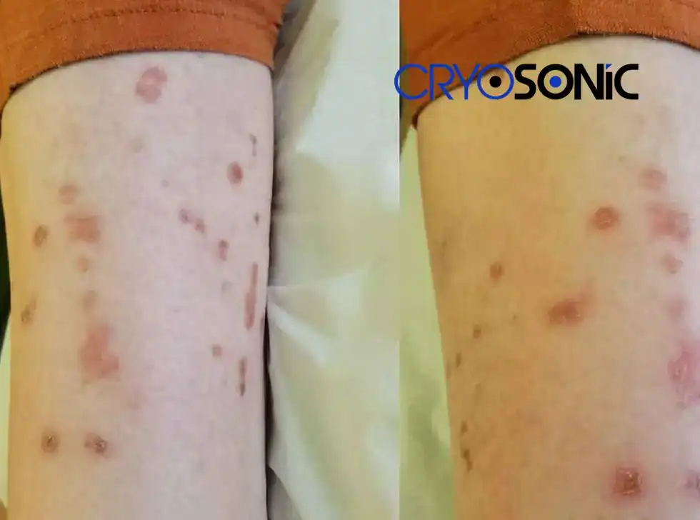 Recovery and Aftercare for Porokeratosis Treatment Henley on Thames Henley on Thames