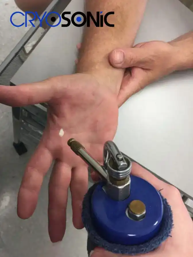 Temperature Differences: OTC vs Medical-Grade Cryotherapy Henley on Thames